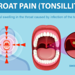 Tonsillitis: Causes, Symptoms and Treatments