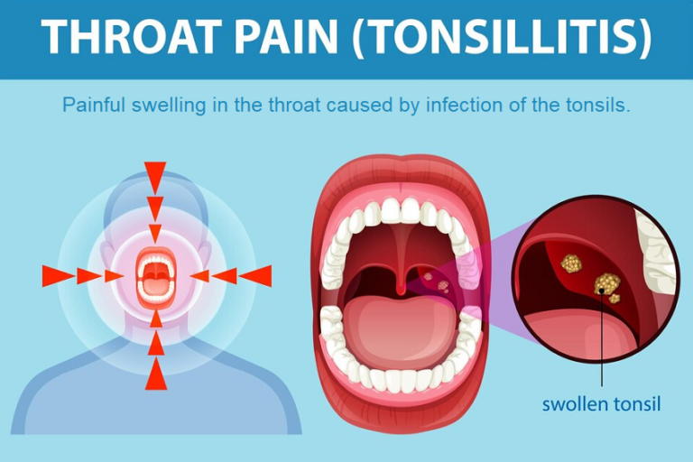 Tonsillitis: Causes, Symptoms and Treatments